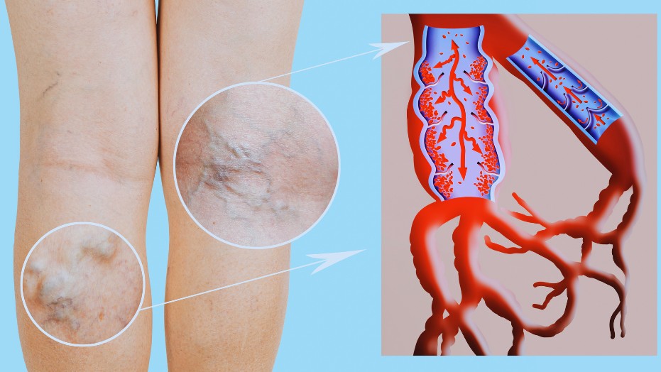 Spider Veins: Common Causes and Available Treatments